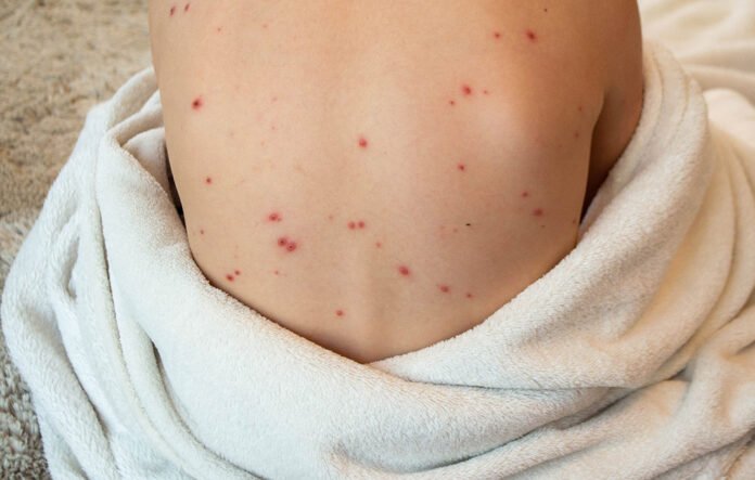 chicken-pox.jpg